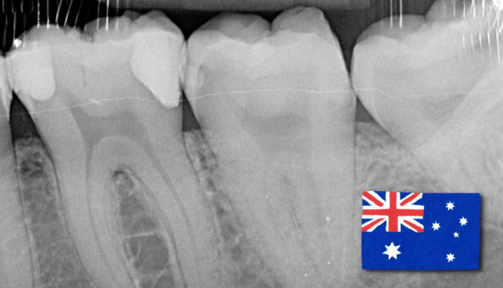 tooth X-ray