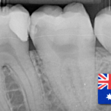 tooth X-ray